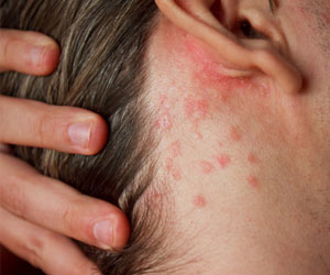 Can Scalp Psoriasis Cause Hair Loss