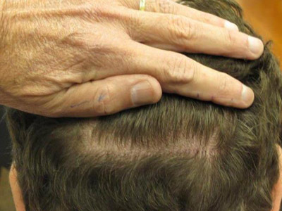 Moving Toward Scarless Hair Transplant