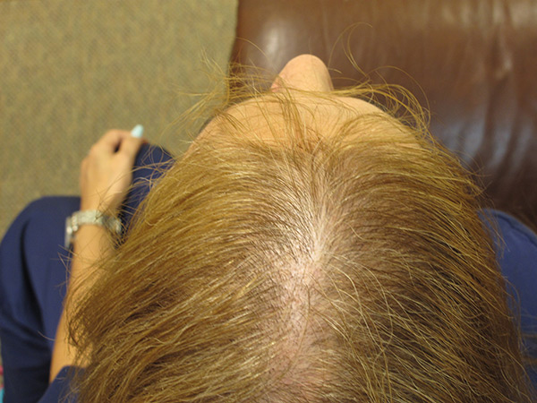 Before Photo: Treating Hair Loss with Stem Cells