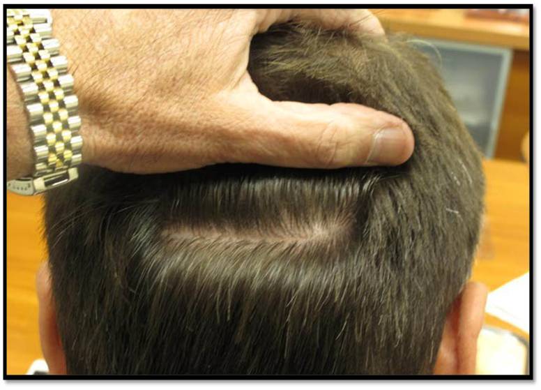 Maintenance After Hair Transplant - Miami Hair Institute