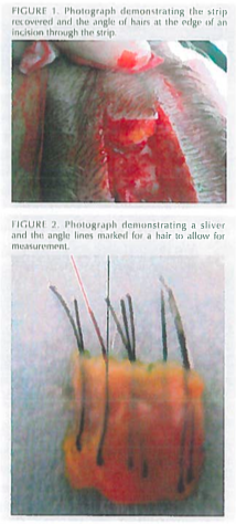 FUE methods