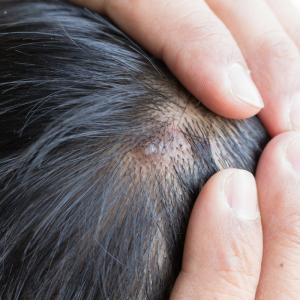 How to Prepare for a Scalp Biopsy