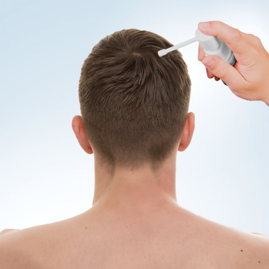 Hair Loss Prevention Plan: Minoxidil (Rogaine®) - Miami Hair Institute