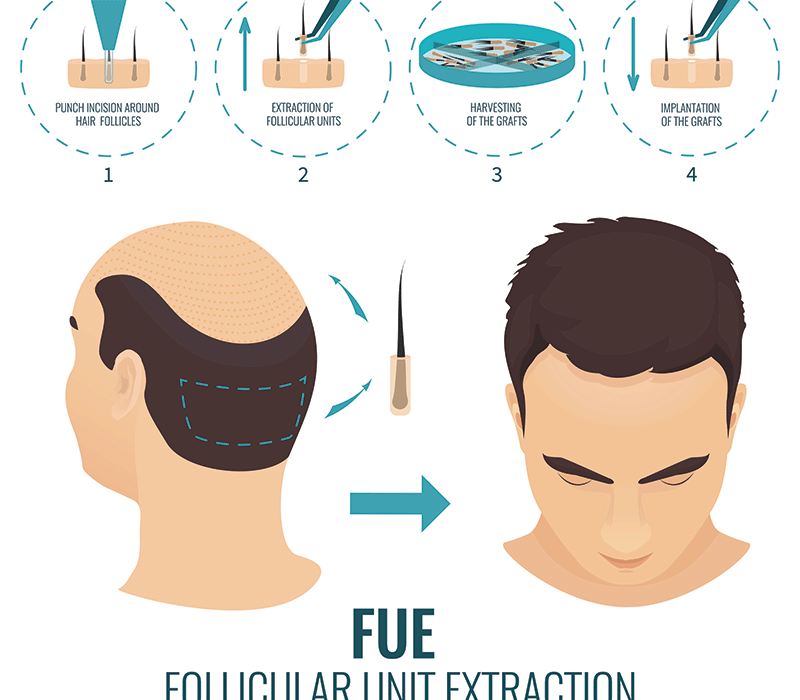 News Everything You Need To Know About Long Hair Transplantation