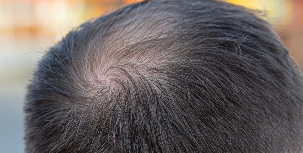 How To Handle a Bald Spot
