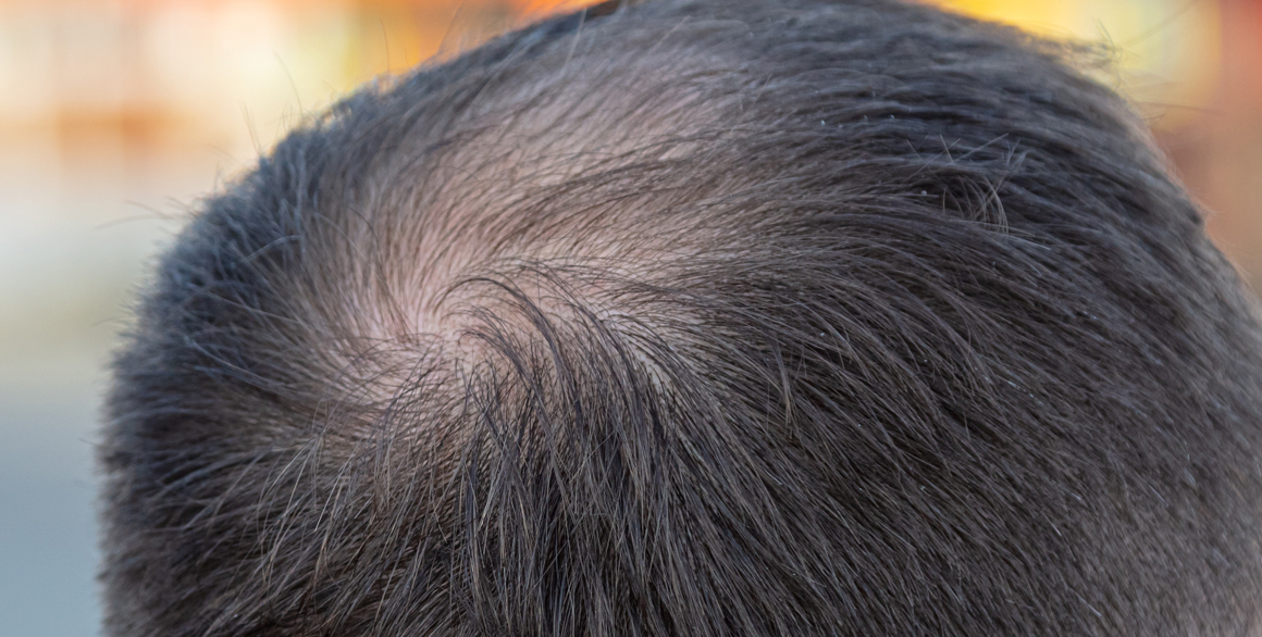 One male hair loss treatment works better than others study finds  CNN