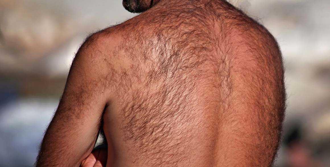 Can Body Hair Be Used for A Hair Transplant Procedure